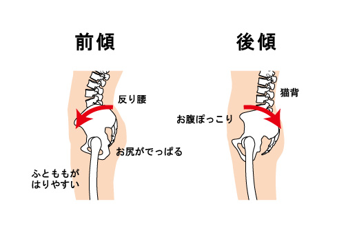 反り腰を治したら痩せる 小林整骨院の体の悩み痛み改善コラム