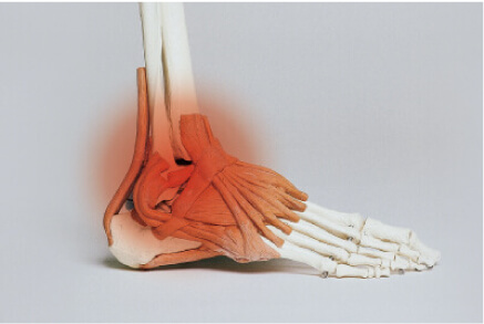 足首の捻挫