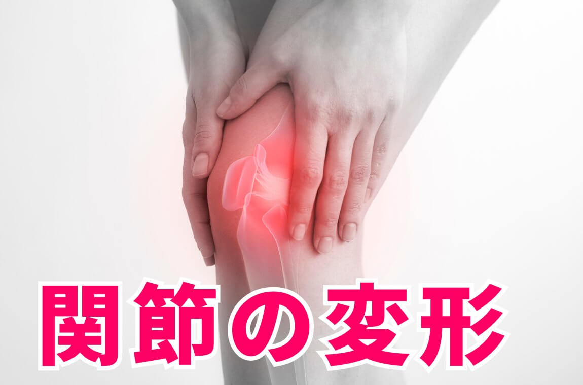 関節の変形（O脚傾向が強くなる）