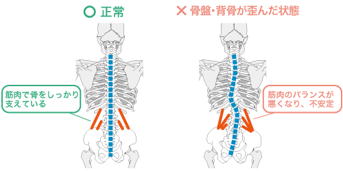 背骨と骨盤の正常な状態と歪んだ状態を表したイラスト